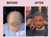 Before and after comparison of a person with hair loss receiving a haircut.