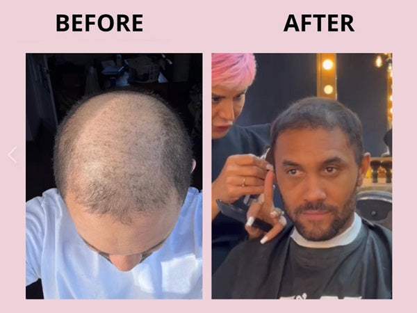 Before and after comparison of a person with hair loss receiving a haircut.